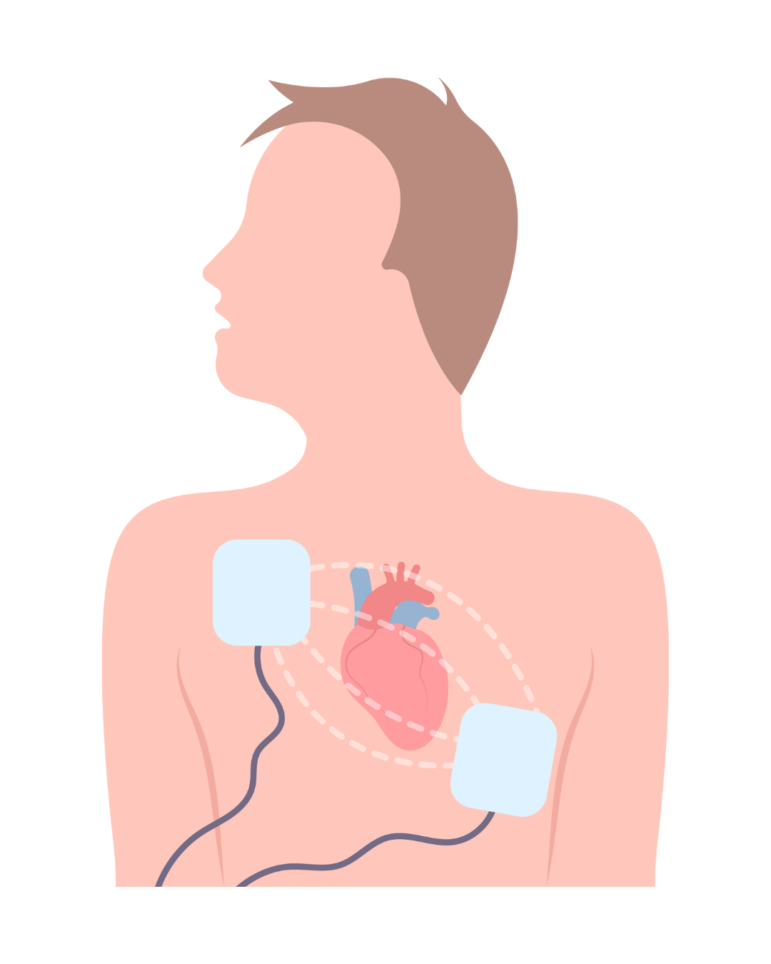 DEFIB AED